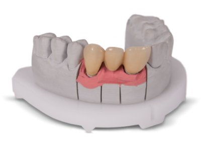 thumbnail_D75_3505_gingiva MASK 3D Impl FZ-bearb